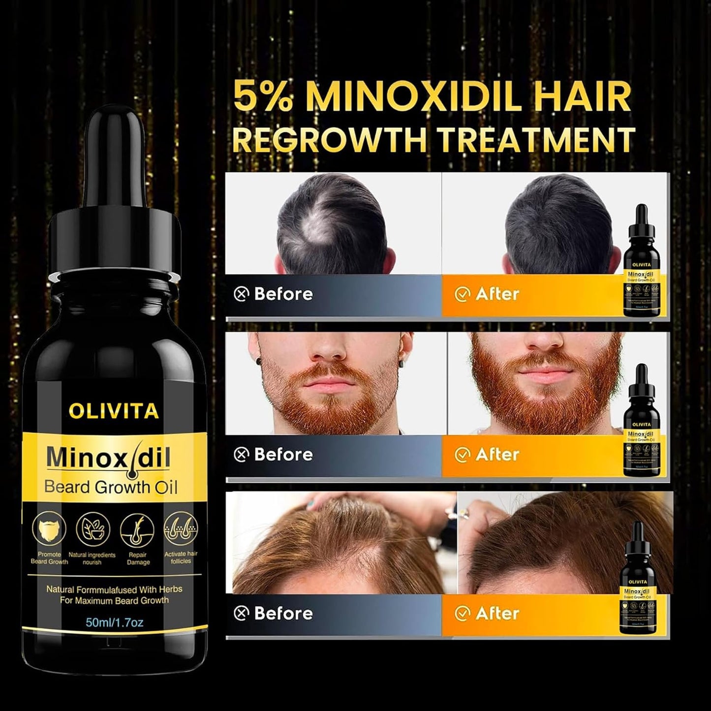 5% Minoxidil Hair Growth Serum, 5% Minoxidil For Men Beard Growth Kit